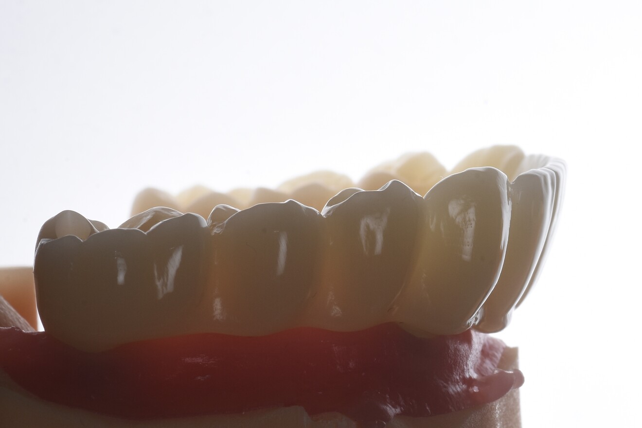 Figs. 8a: Screw-retained PMMA provisional restoration. 