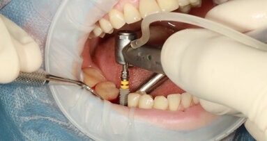 Yapay Zeka, Peri-implantitis Riskini Tahmin Edecek