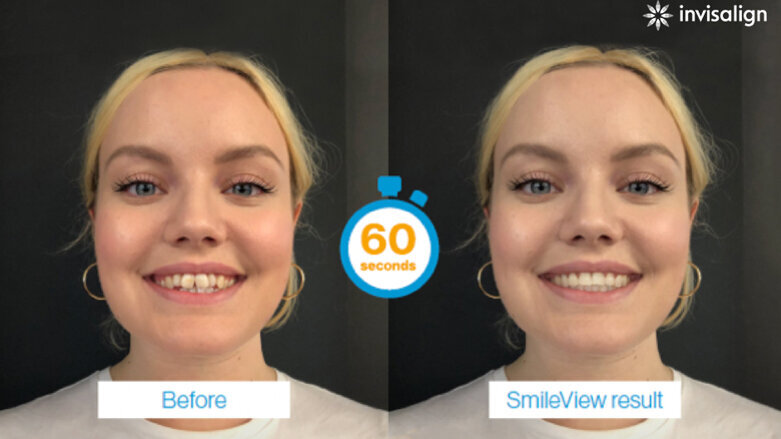 Align takes another step forward in the clear aligner industry