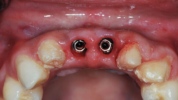 Implant uncovery with the Picasso diode laser