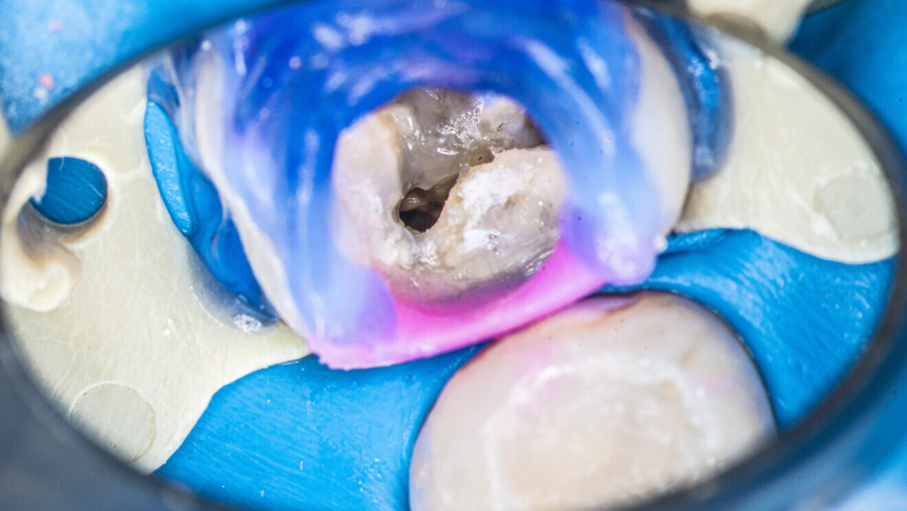 Fig. 32: Root canal orifice sealed with flowable composite.