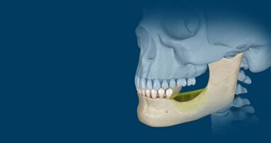 Orthognatic Surgery: Understanding the basics