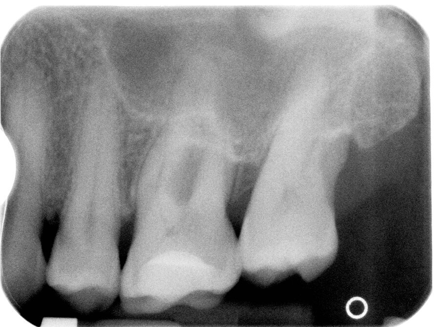 Fig. 5l - Radiografia ad 1 anno.