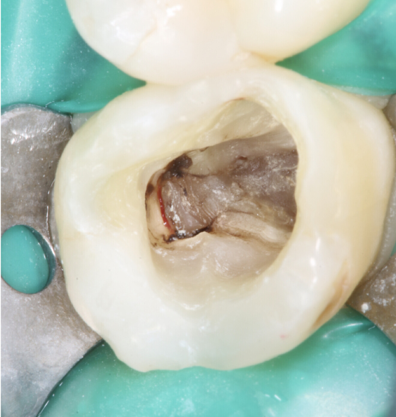 Fig. 3: Large residual pulp stone completely obstructing the palatal canal.