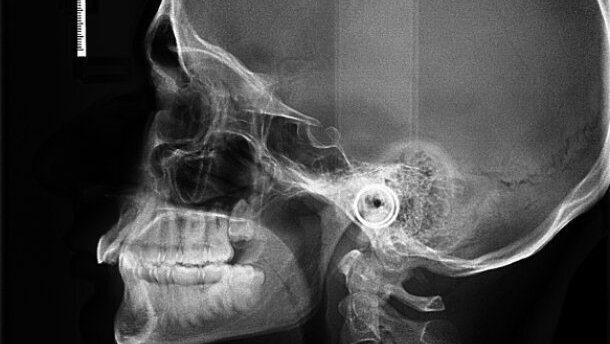 Widening the scope of aligner application: A case report