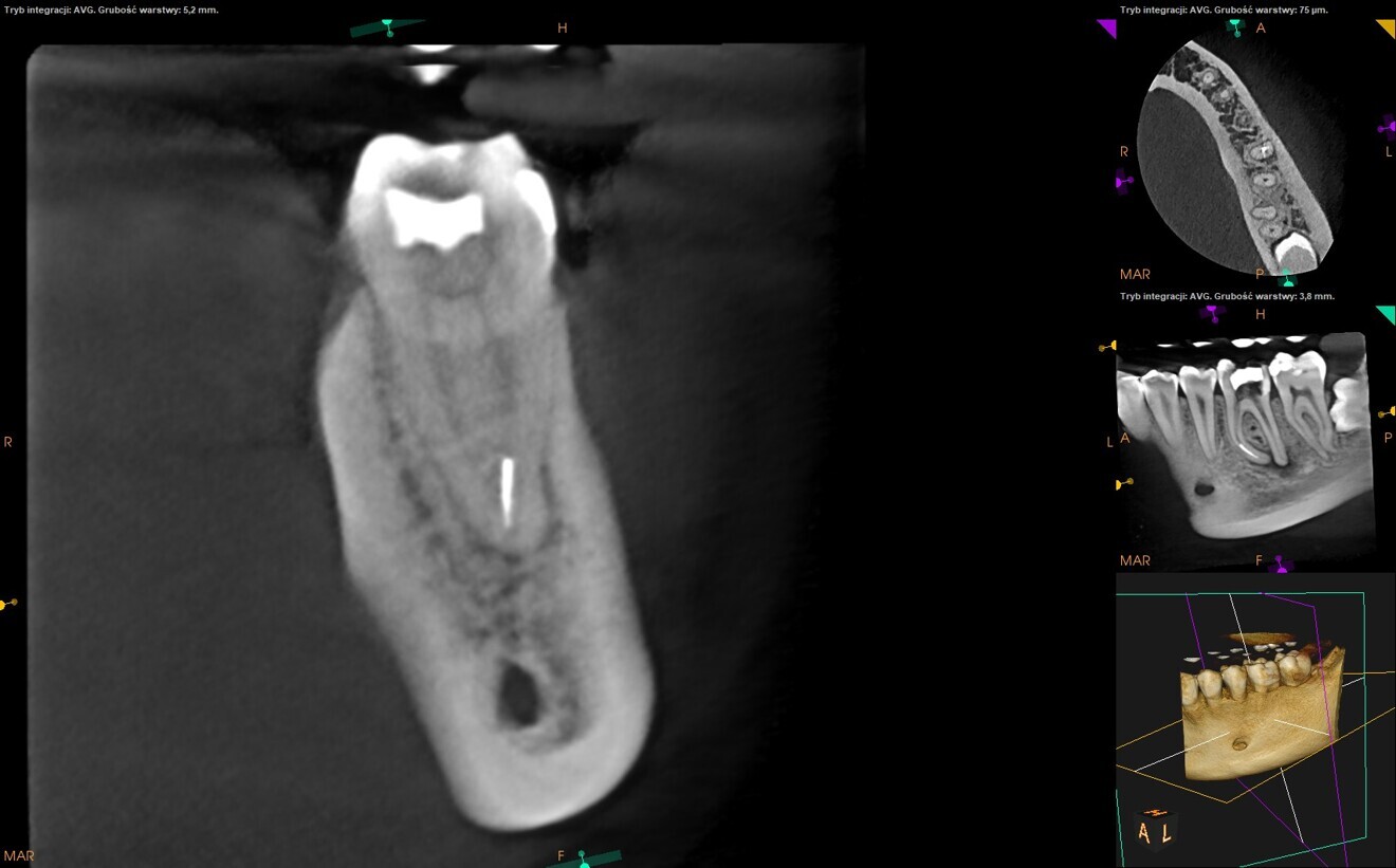 Fig. 3: Pre-op CBCT scan. Tip of the broken file located below the junction of the mesiobuccal and mesiolingual canals.