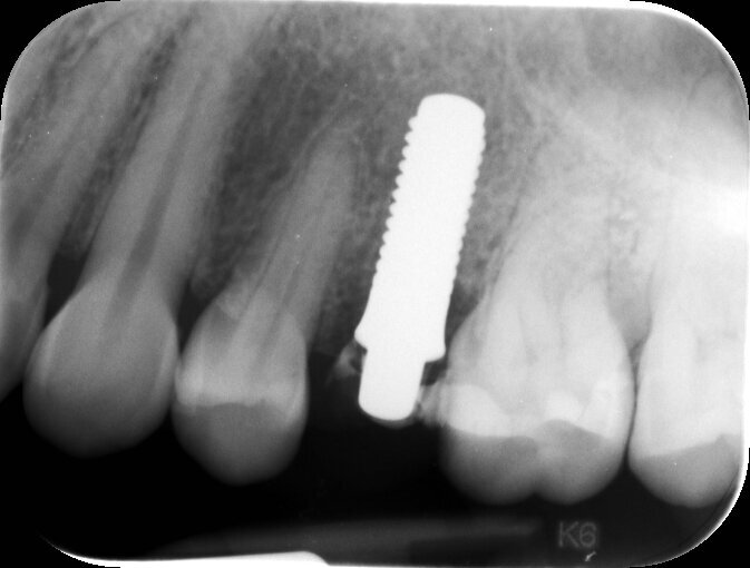 Fig. 5_Rx di controllo post operatoria con provvisorio in situ, serve per stabilire la posizione dell’impianto in tempo post chirurgico e per valutare se vi è del residuo cementizio al di sotto della corona provvisoria.
