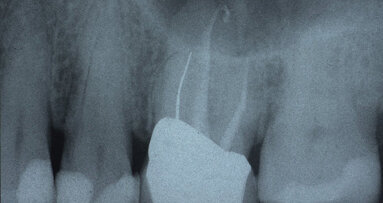 The utility of cone-beam computed tomography in endo