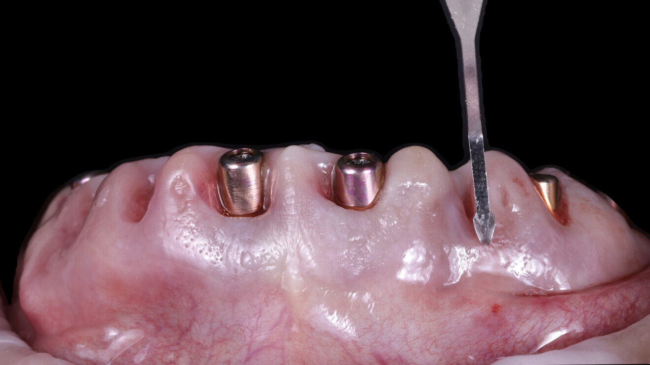Fig. 19: Soft-tissue deficit in the area of tooth #12 that was to receive a connective tissue graft. 