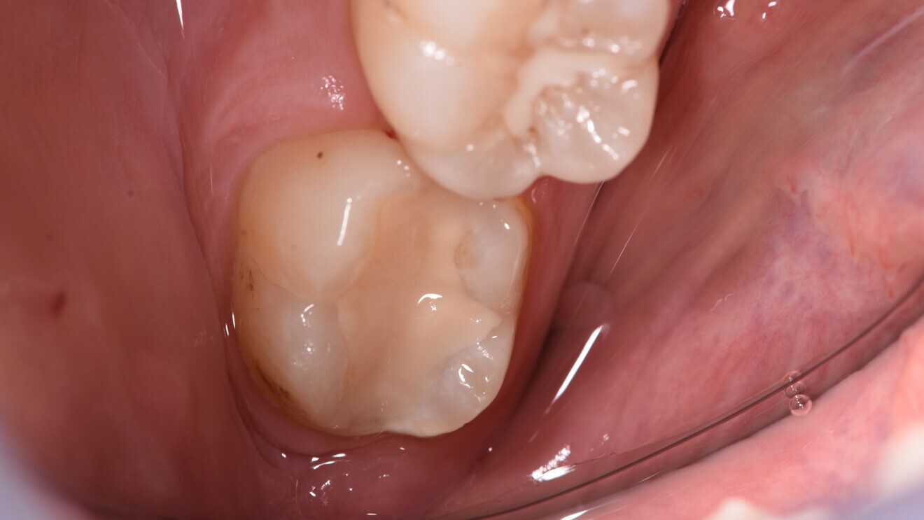 Fig. 6: Glass hybrid restoration at follow-up, three years after placement. 