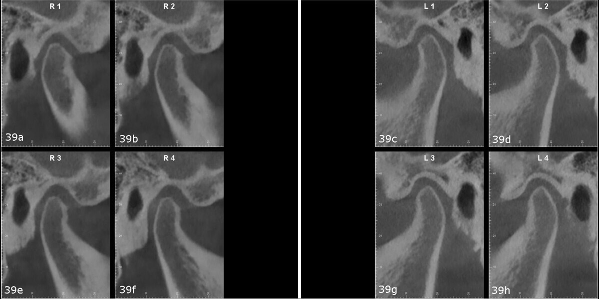Figs. 39a–h: Temporomandibular joint sagittal images from the CBCT scan.