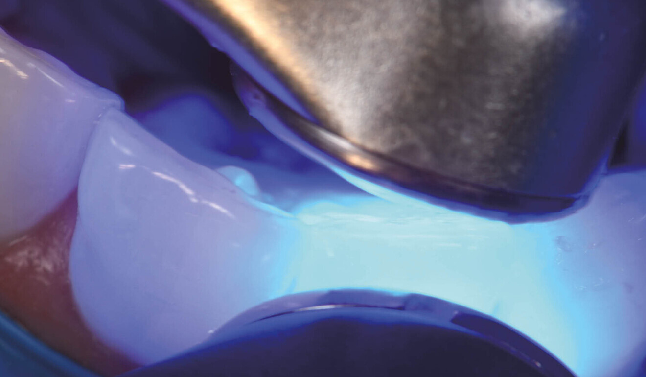 Fig. 8: Final polymerisation of the veneers from both palatal and facial aspects simultaneously.