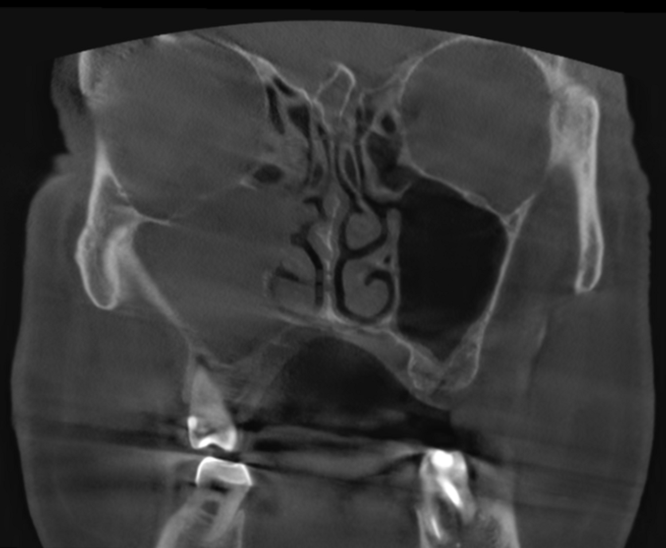 Fig. 3: Large-volume CBCT scan, frontal cross-section showing increased radiopacity in the paranasal sinus area.