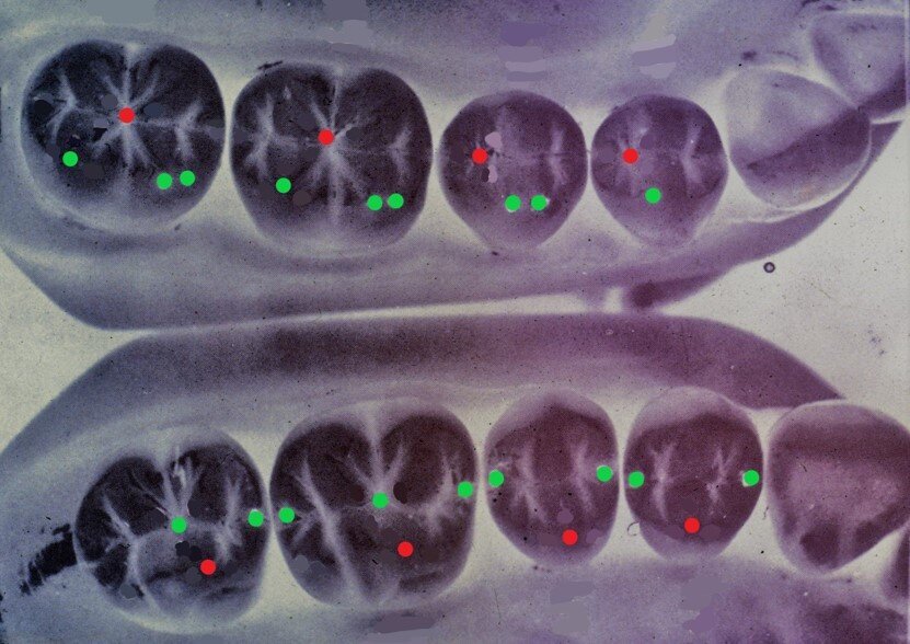 Fig. 3 - Occlusione semplificata secondo Wiskott: Modellazione di tipo 1= 16 punti di contatto; Modellazione di tipo 2= 36 punti di contatto.