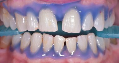 Tecnologia innovativa  per lo sbiancamento: pratica clinica che migliora la vita  di relazione della persona assistita. Case report