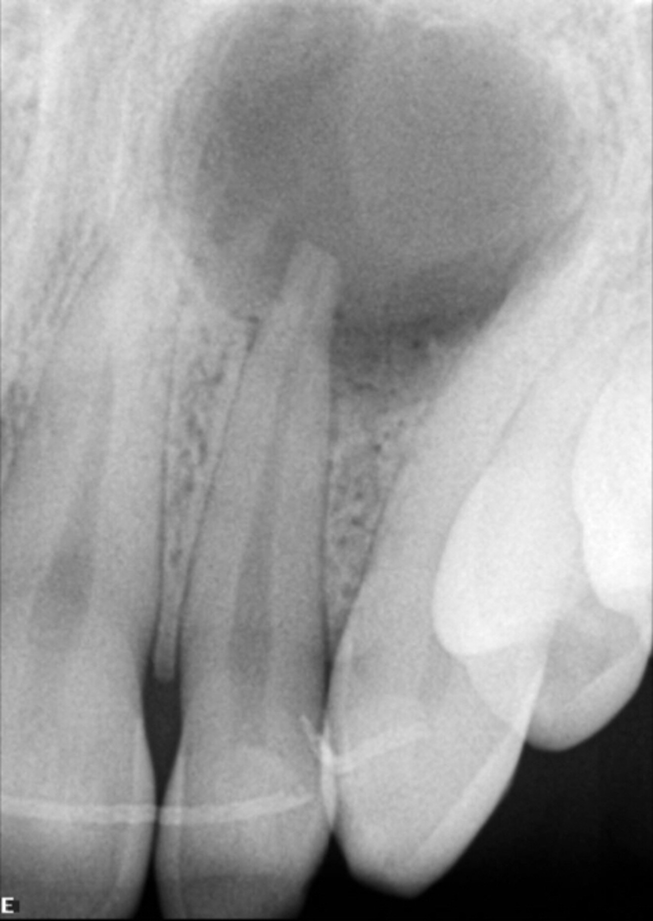 Fig. 5a: Initial radiograph.