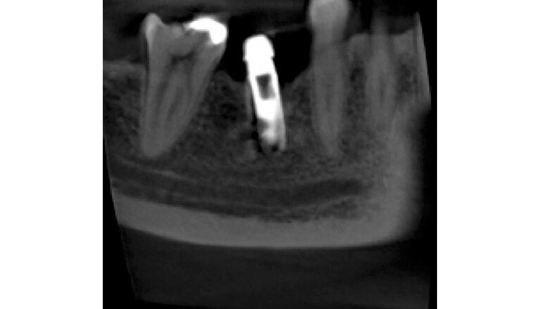 Fig 2. Tomografía inicial. En distal del implante se observa un halo hipodenso desde el reborde, que se dirige a la parte apical, lo que es compatible con peri-implantitis; a nivel del reborde óseo mesial y distal observamos pérdida ósea. Como indican las flechas, se realiza una descontaminación con láser de erbio cromo YSSG alrededor del implante que remueve todo microorganismo.