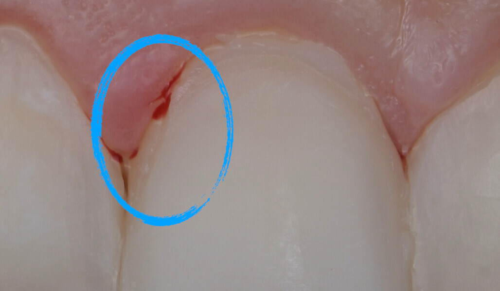 Fig. 9: Composite surface with a defect near the margin with blood contaminating the affected area.