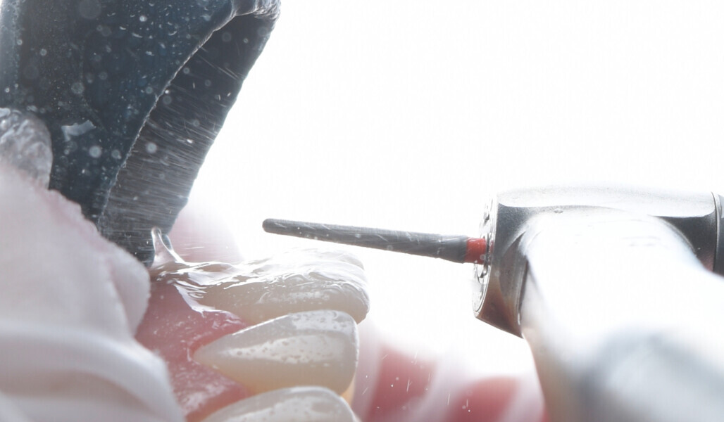 Fig. 3: Tooth preparation with rotating instruments.