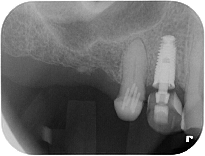 Fig. 17: Provisional restoration in place after implant placement.