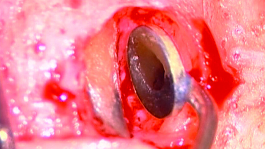 La terapia clinica e chirurgica delle perforazioni iatrogene
