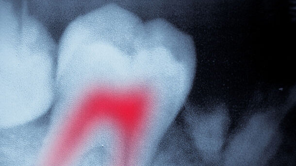 Study reveals that post-endo pain has different sources