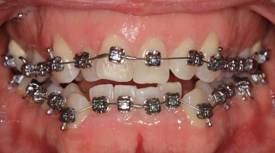 Initial treatment