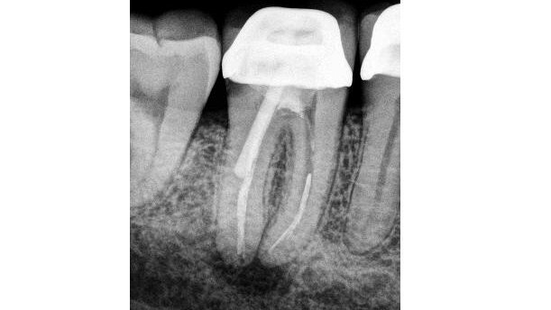 The lazy man’s guide to persistent apical periodontitis