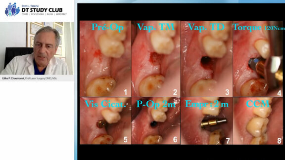 Webinaire en libre accès : applications du Waterlase en implantologie et chirurgie orale