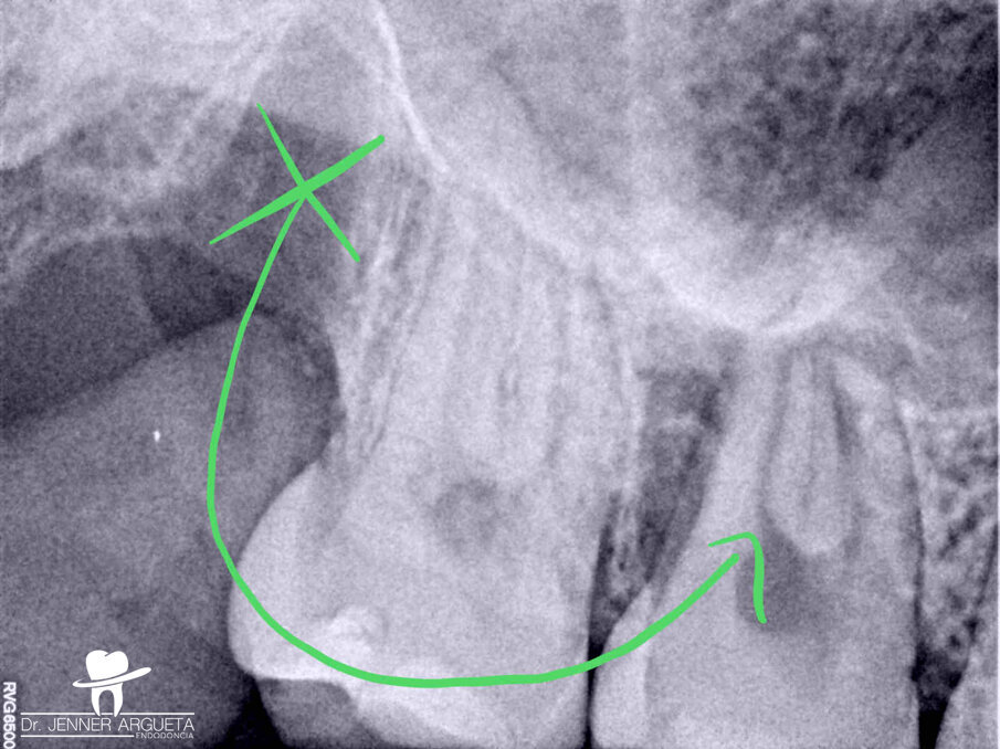 Fig. 3: Tooth #18 transplanted to
the site previously occupied by tooth #16.
