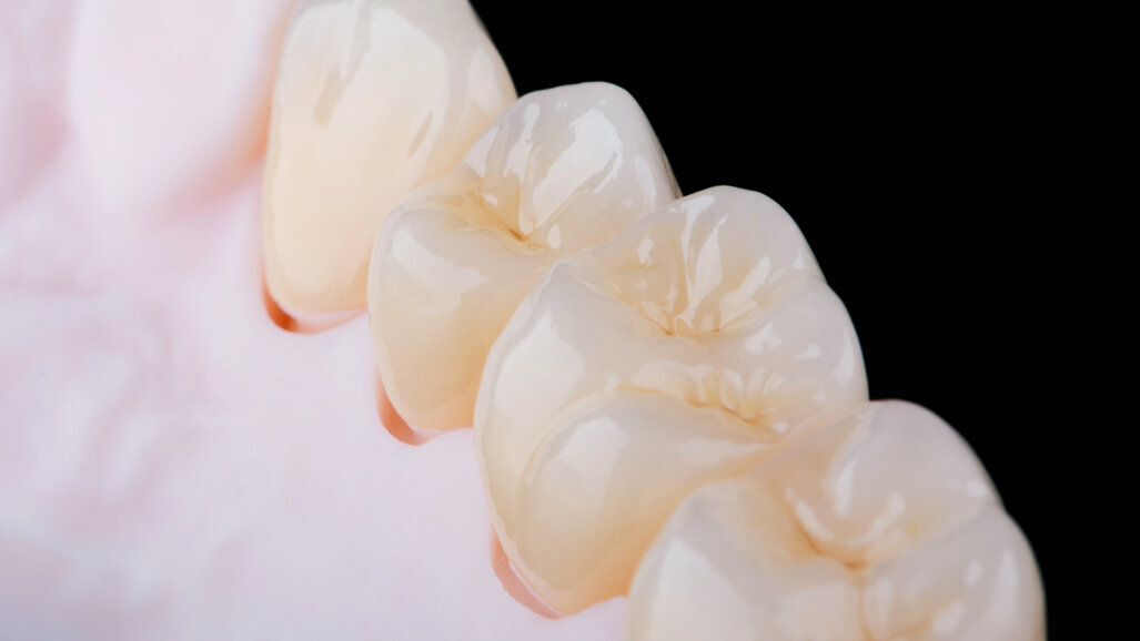 3D-printed ceramics show promise for dental restorations