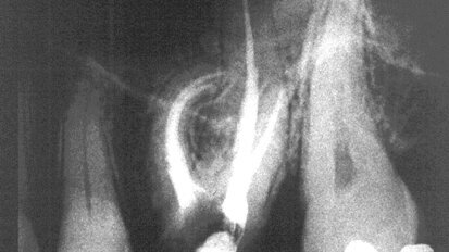 Taktilna percepcija u endodonciji