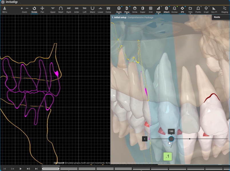 CBCT integration within the ClinCheck software provides enhanced visualisation and precision for complex orthodontic cases.