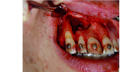 Interdisciplinary approach to treatment of maxillary radicular cysts: Minimization of surgical invasiveness and medication load