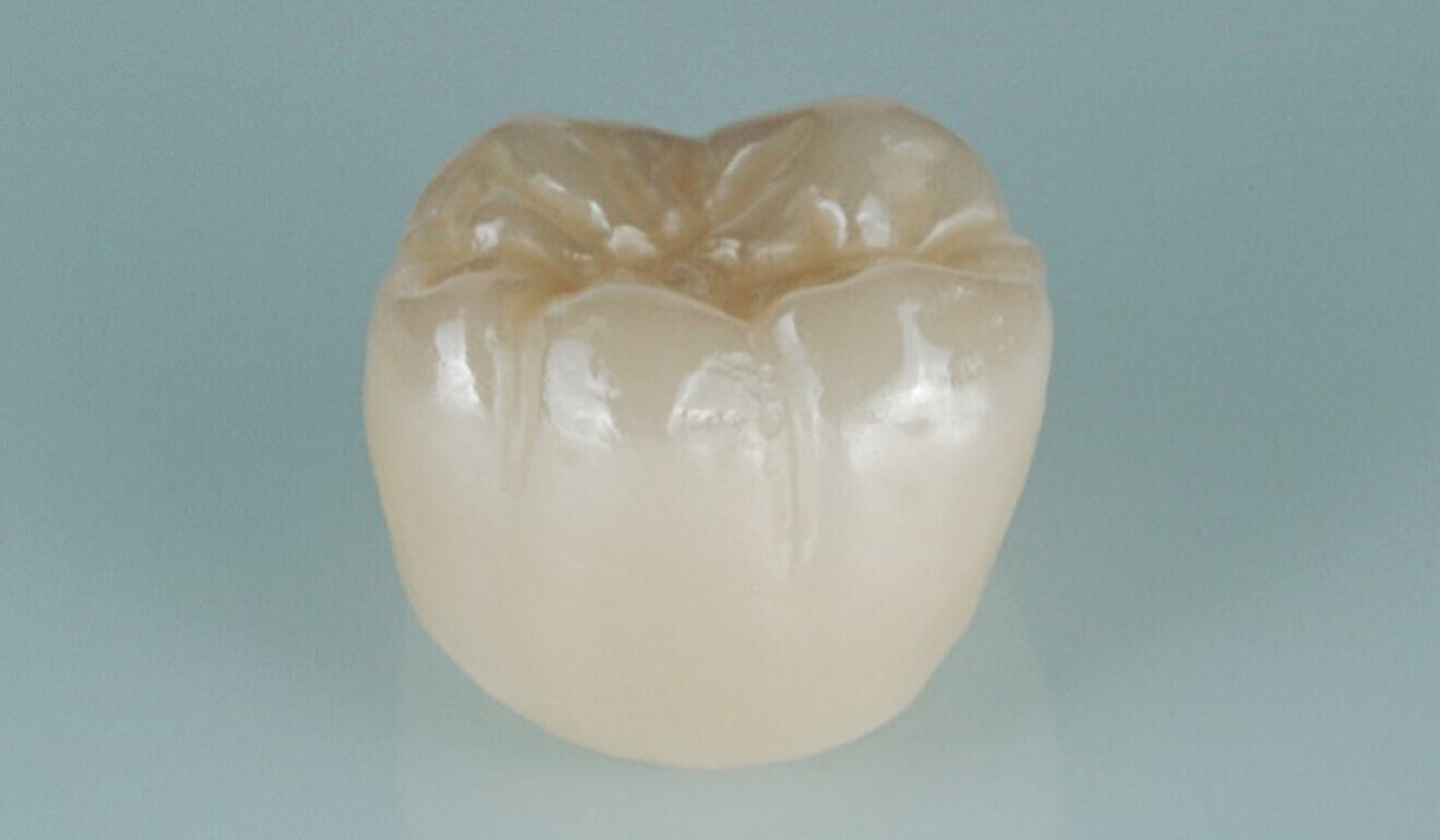 Fig. 2: Occlusal high-gloss polish. 