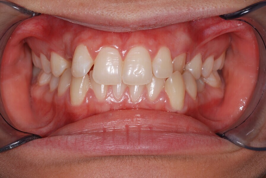 Fig. 11: Intra-oral view with the teeth in occlusion before treatment.