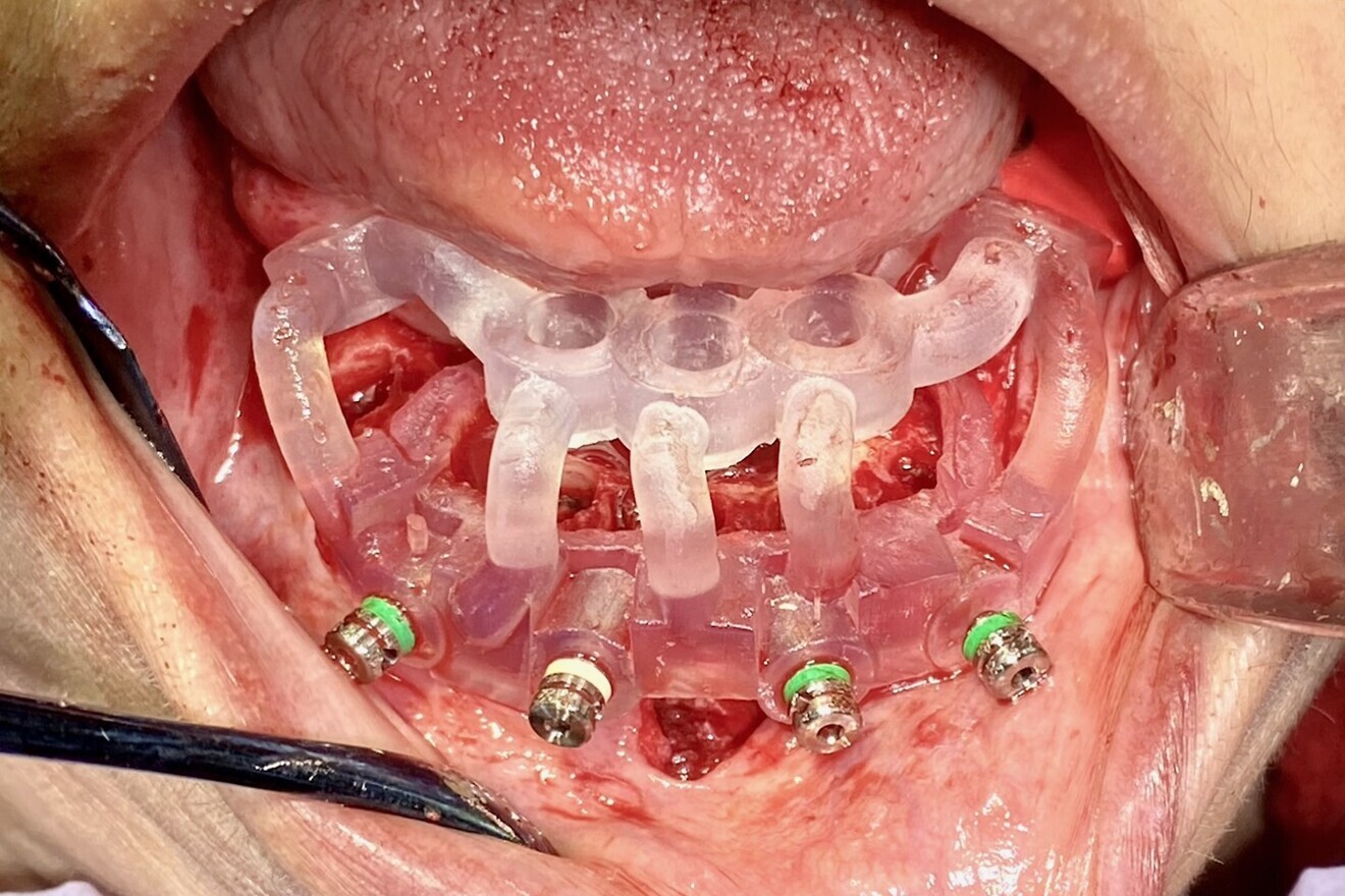 Fig. 13: Surgical guide fixated to the mandible.
