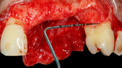 How to use Straumann biomaterials—an overview for dental students