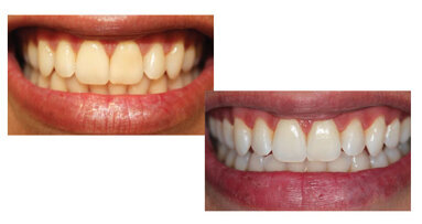 Aclaramiento en el consultorio de dientes vitales y no vitales