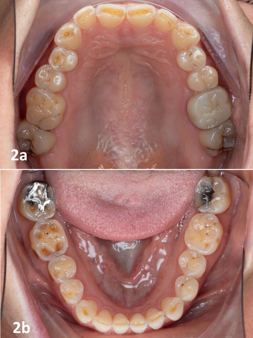 Figg. 2a & b: Viste occlusali intraorali prima del trattamento che mostrano solchi incisali e marcate concavità occlusali, compatibili con una componente erosiva dell’usura dentale. Il lato destro era più gravemente interessato rispetto al sinistro, indicando potenzialmente un carico occlusale asimmetrico.