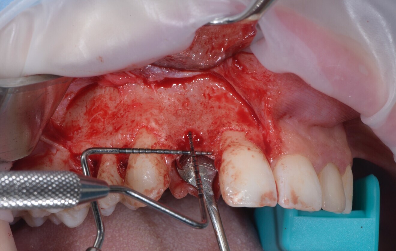 Fig. 4: Vertical guided bone regeneration procedure carried out after an eight-week healing period by experienced operators.