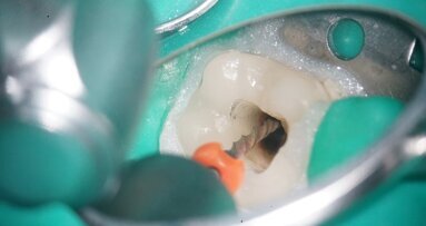 Retreatment of a carrier-based root filling with bypassing of two ledges