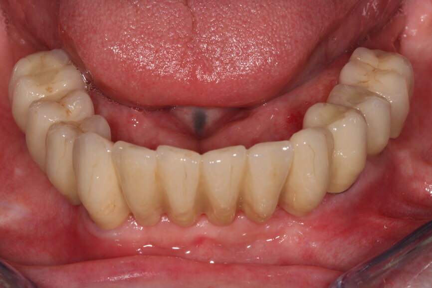 Fig. 17: Finished screw-retained bridge in situ.