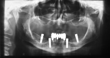 Restauration implantaire assistée par ordinateur chez des patients atteints d’une tumeur