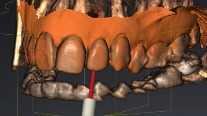 Calcified canals: A new approach to an old problem