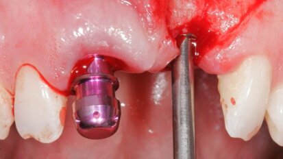 Estetyka różowa i biała – implantacja w odcinku przednim z natychmiastowym obciążeniem przy użyciu implantów MIS C1