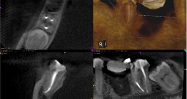 Efektywność wypełnienia kanałów w leczeniu endodontycznym z zastosowaniem CBCT