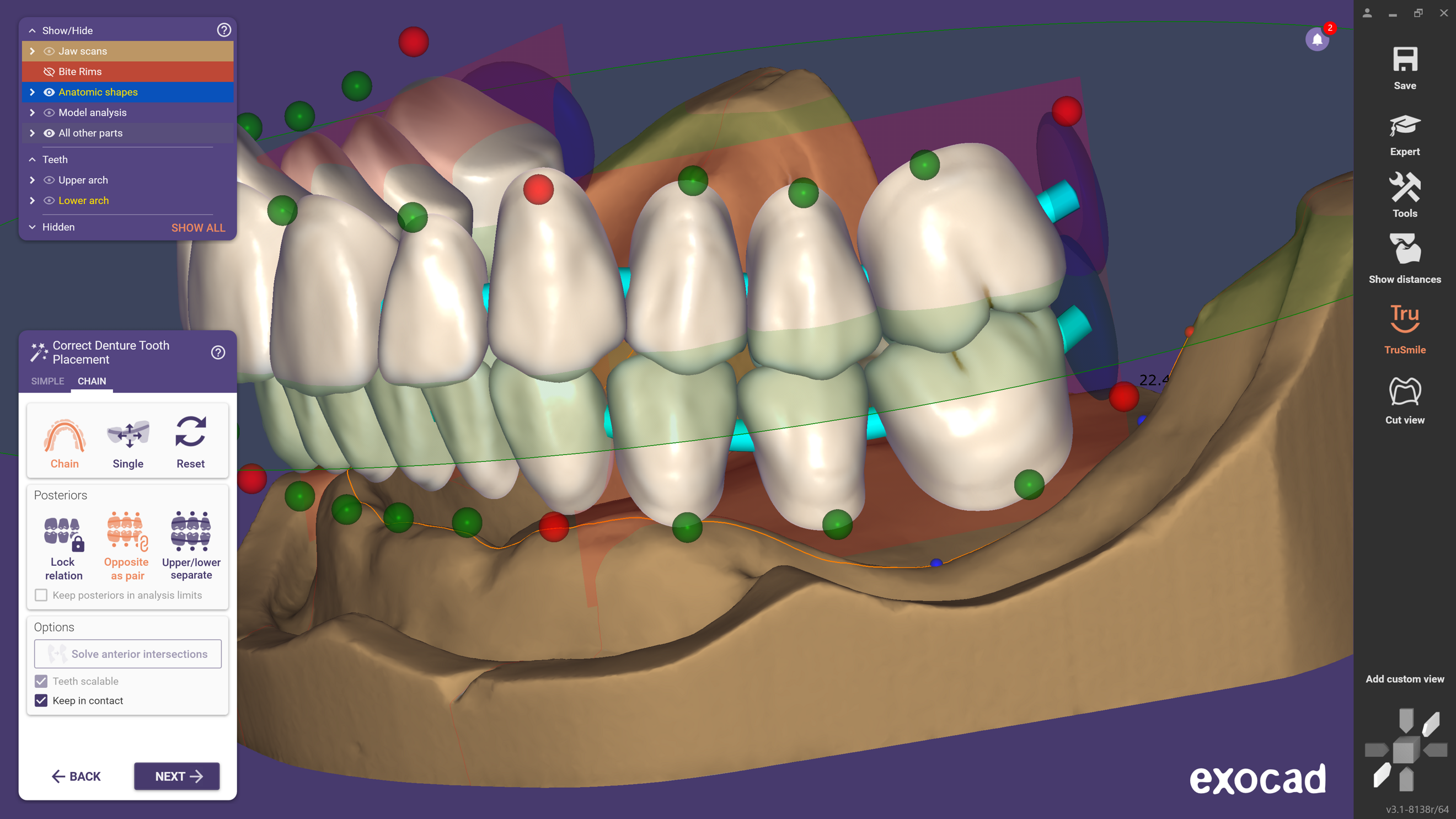 Dental News - Reduce design time with exocad’s DentalCAD 3.1 Rijeka ...