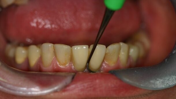 Periimplantitis i mucositis – od diagnozy do leczenia; opisy przypadków