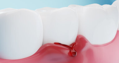 Study uses artificial intelligence for gingivitis detection